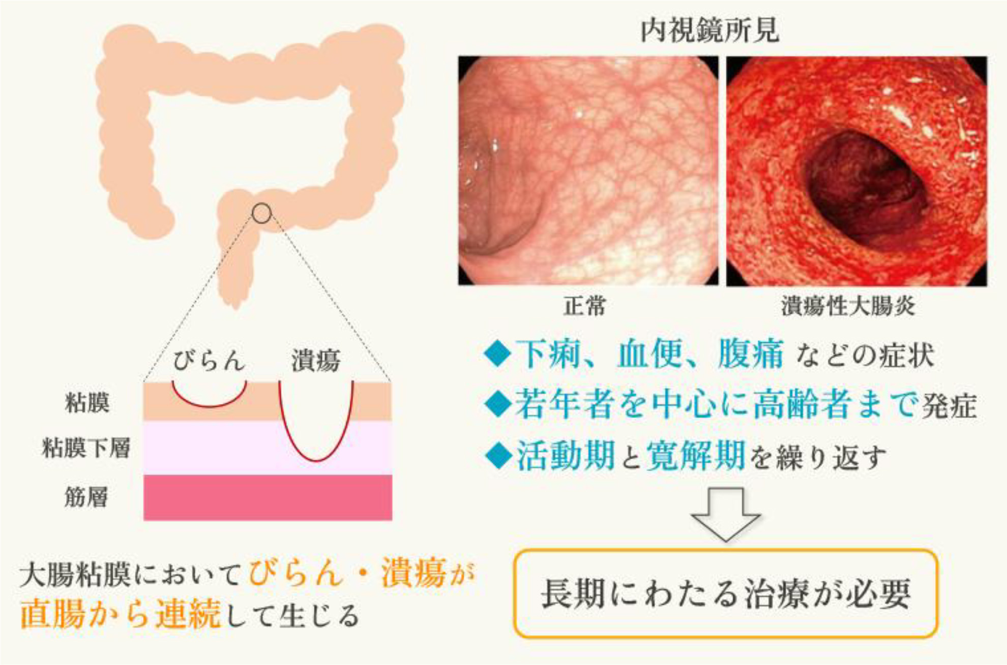 潰瘍性大腸炎の診断 ttl=